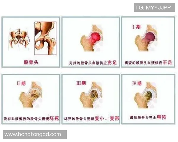 足球明星的胯骨肌肉对运动表现的影响与训练方法探讨